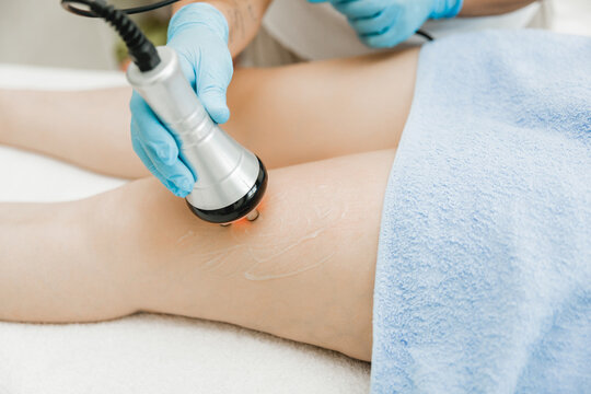 Radio Frequency for Thigh Fat