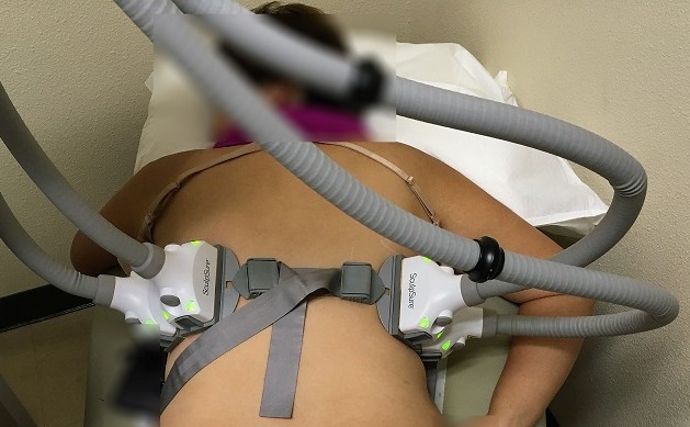 SculpSure for Back Fat